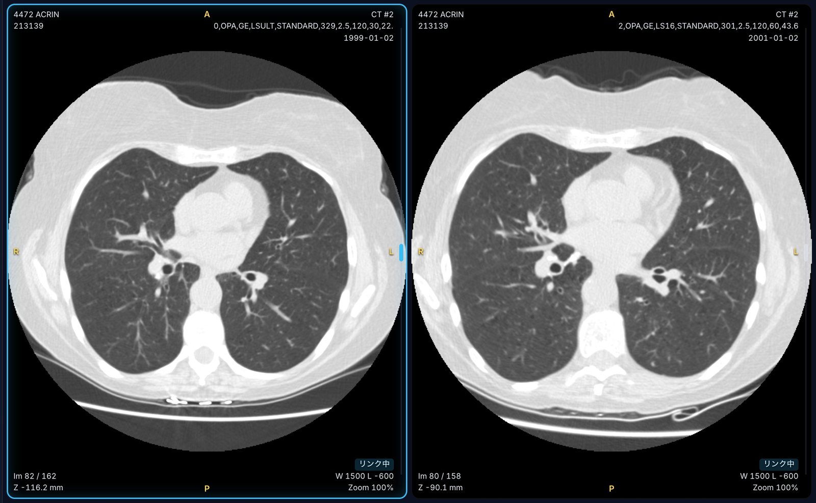 2 年前の CT と並べて比較読影している画面
